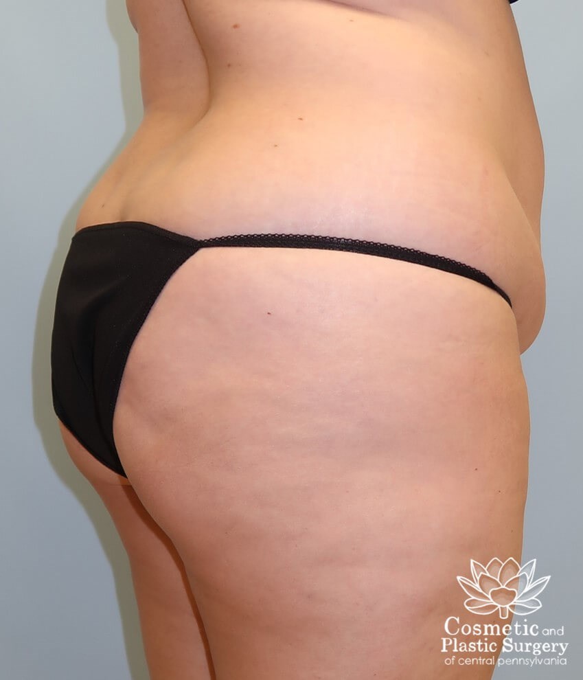 Abdominoplasty (Tummy Tuck) Before