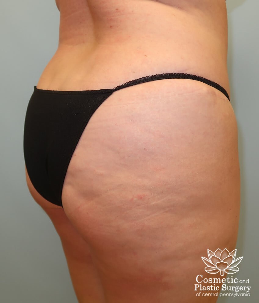 Abdominoplasty (Tummy Tuck) After