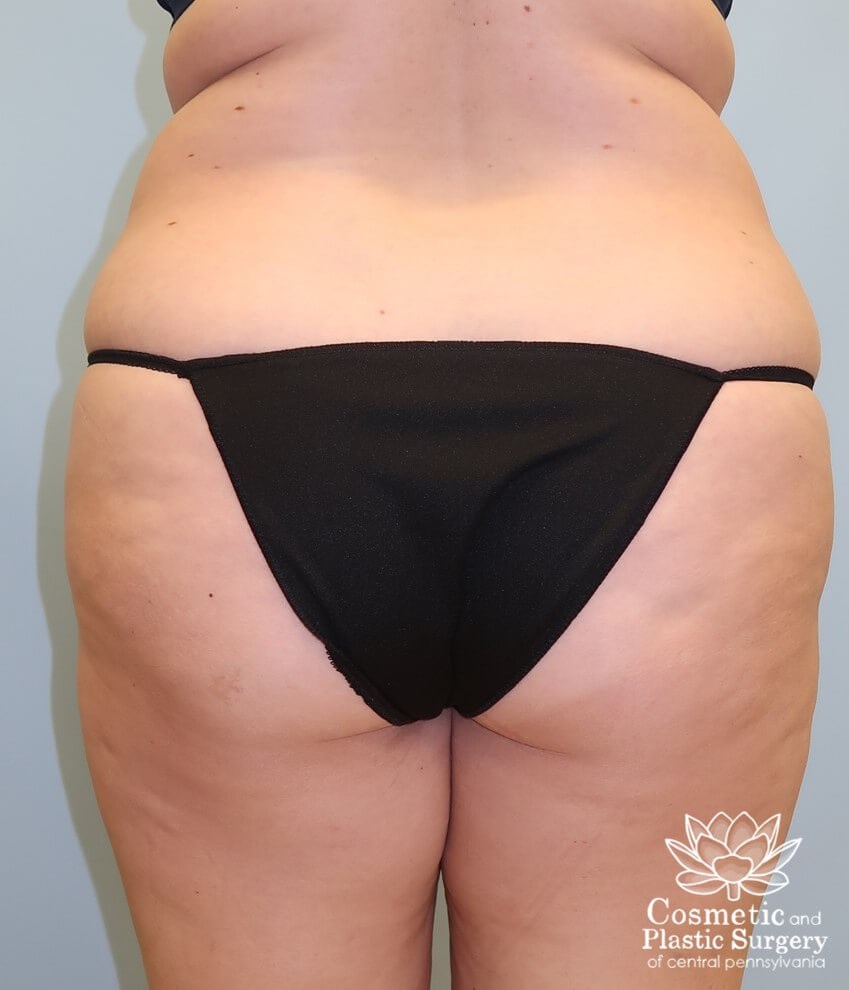 Abdominoplasty (Tummy Tuck) Before