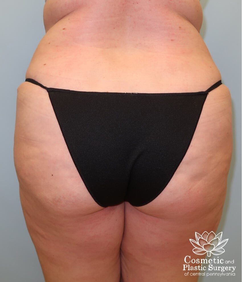 Abdominoplasty (Tummy Tuck) After