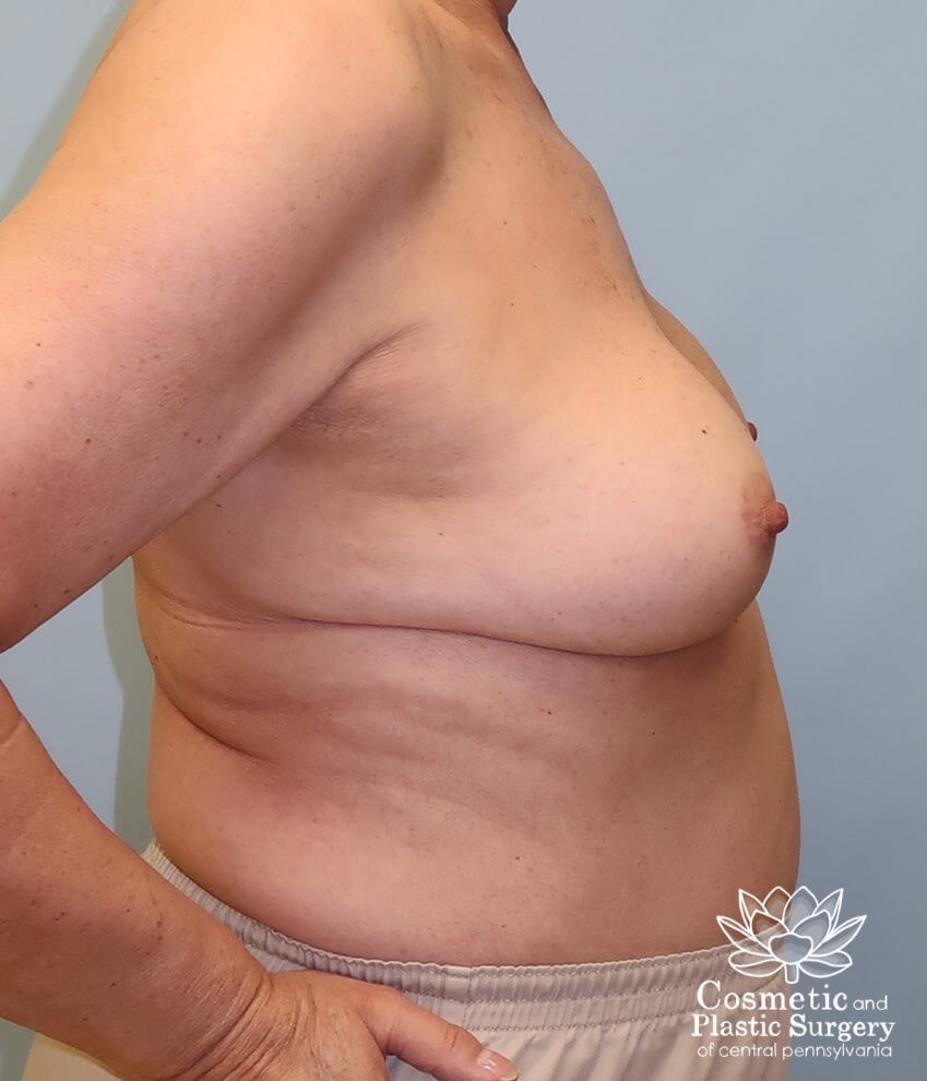 Breast Augmentation Revision Before