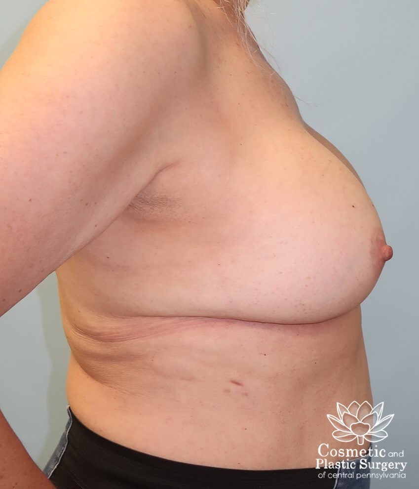 Breast Augmentation Revision After
