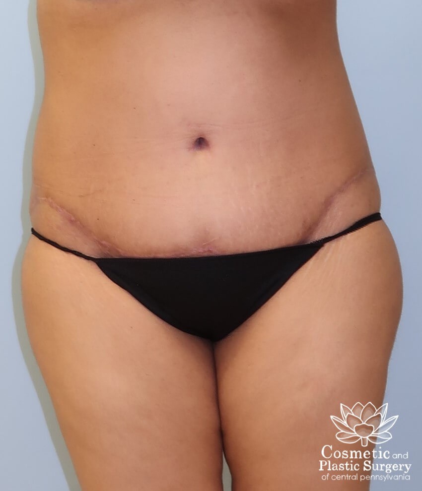 Tummy Tuck After
