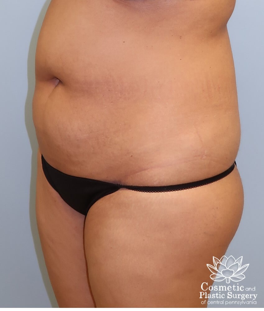 Tummy Tuck Before