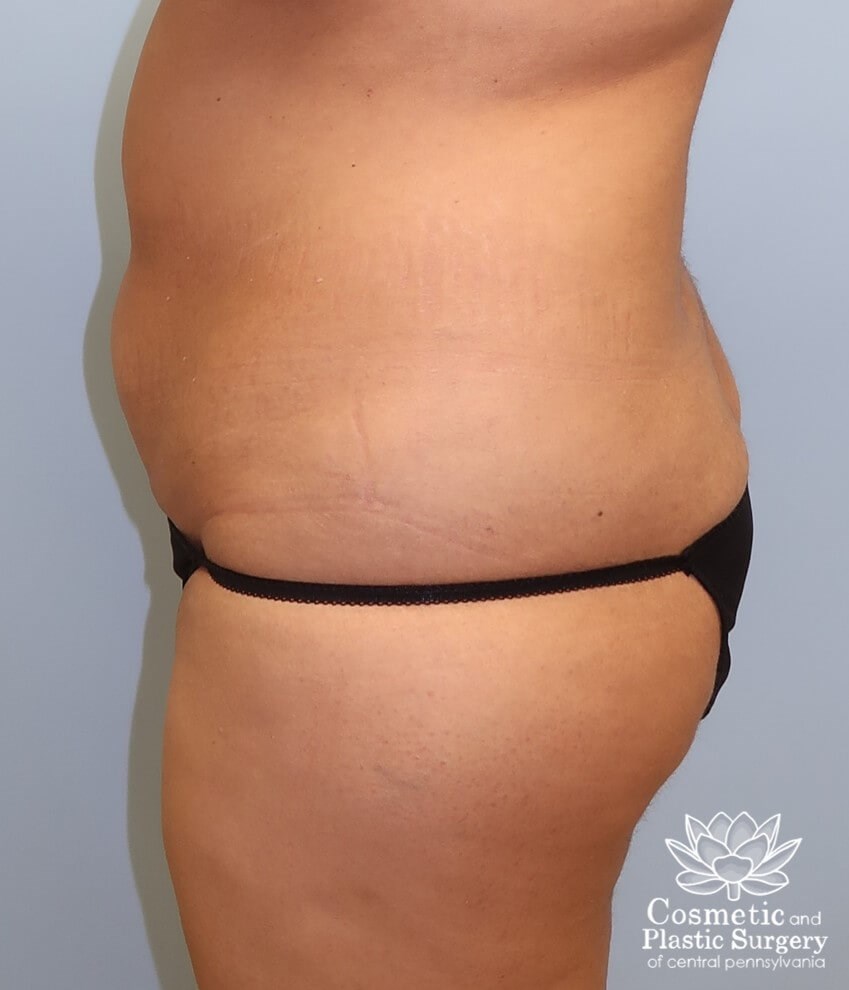 Tummy Tuck Before