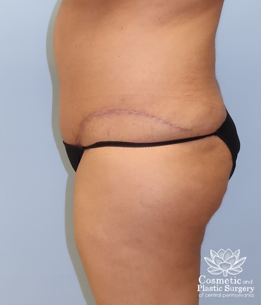 Tummy Tuck After