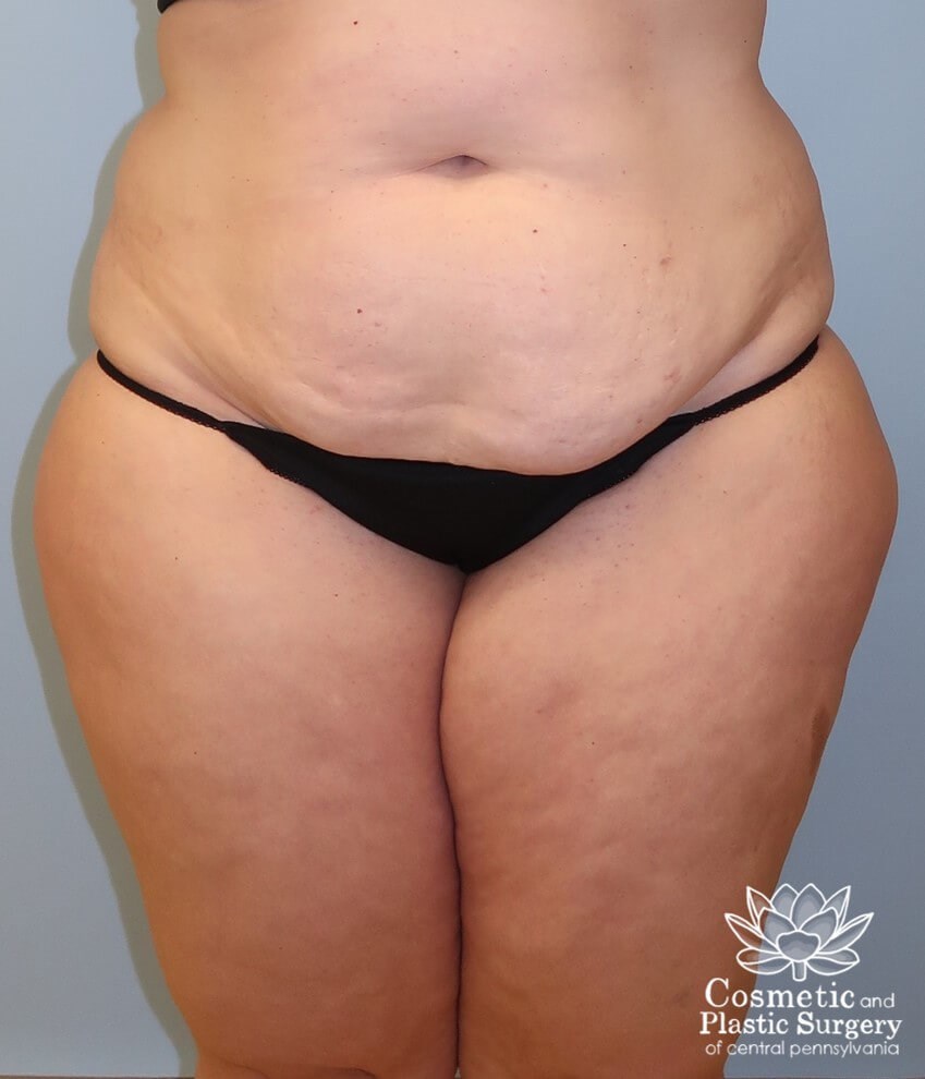 Tummy Tuck Before