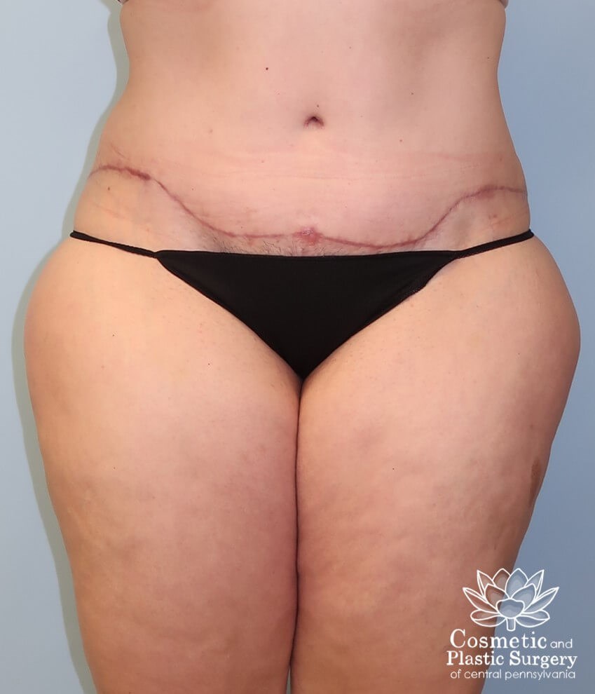 Tummy Tuck After
