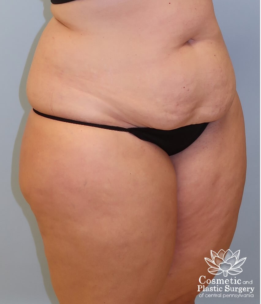 Tummy Tuck Before