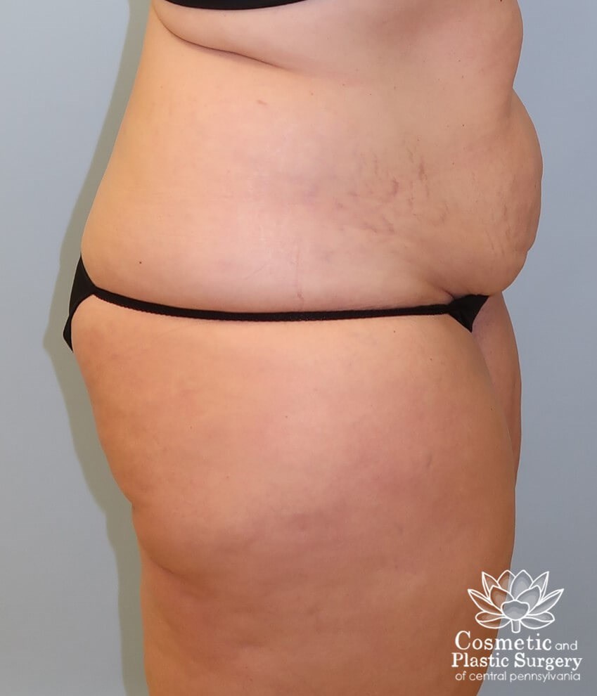 Tummy Tuck Before