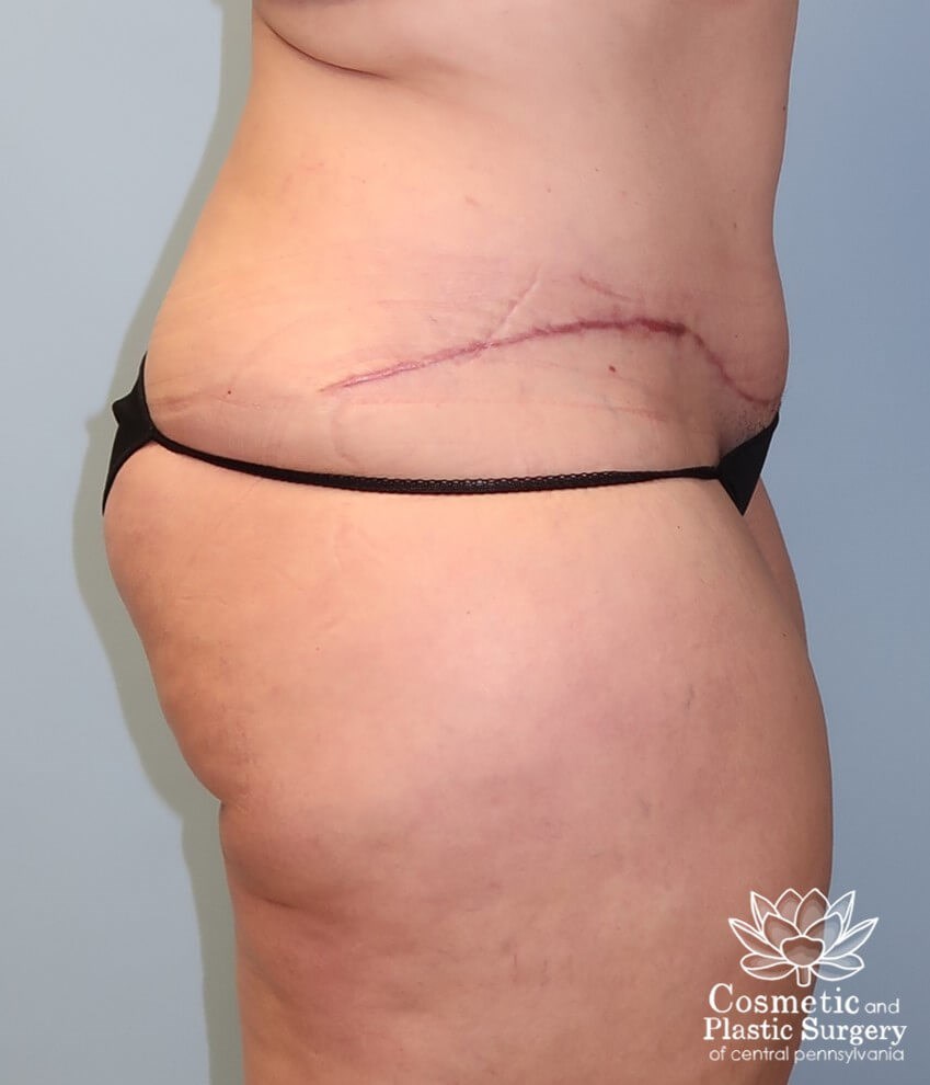 Tummy Tuck After