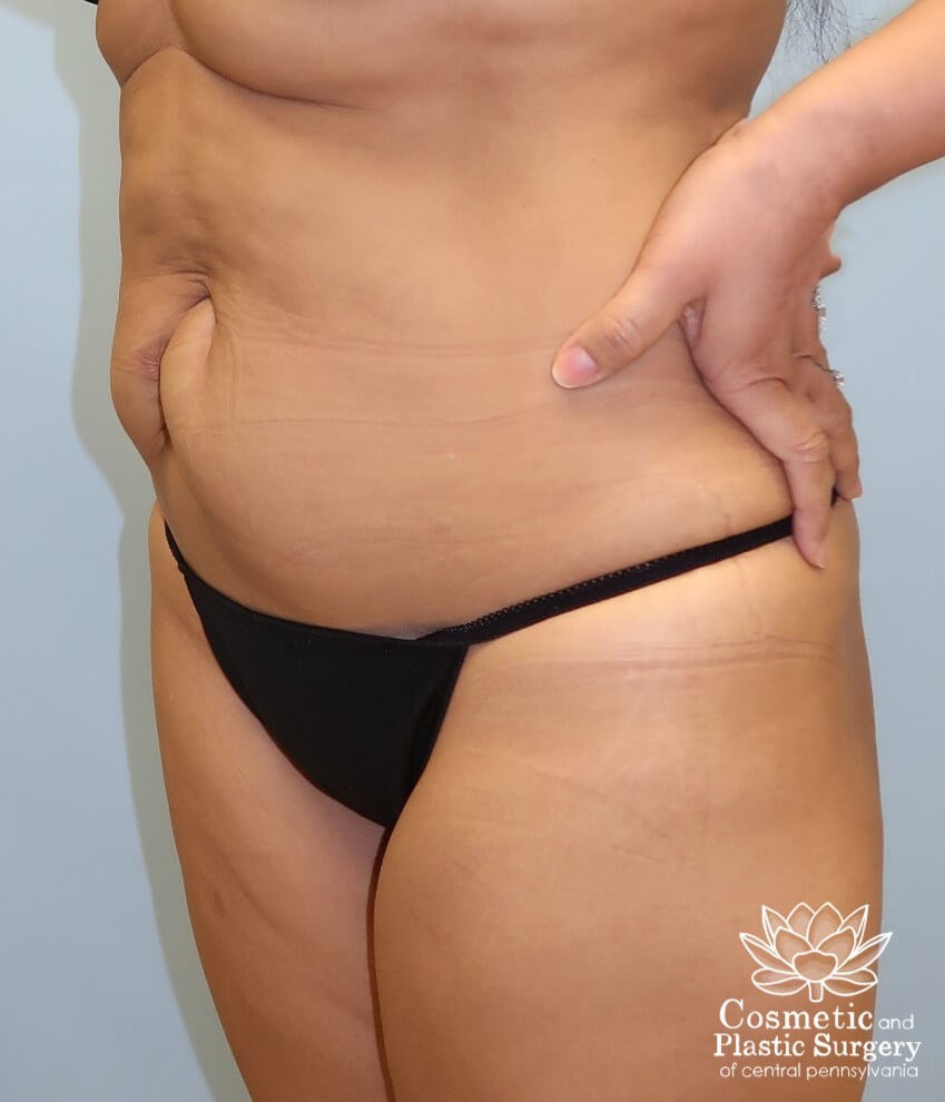 Abdominoplasty (Tummy Tuck) Before
