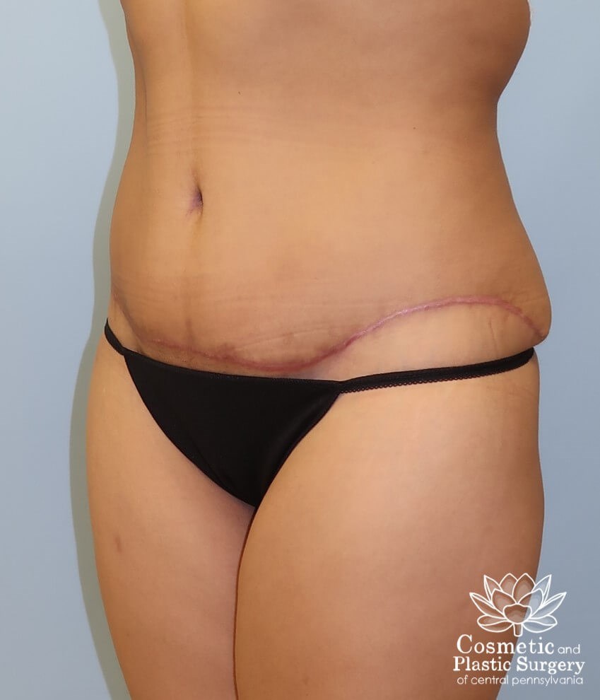 Abdominoplasty (Tummy Tuck) After