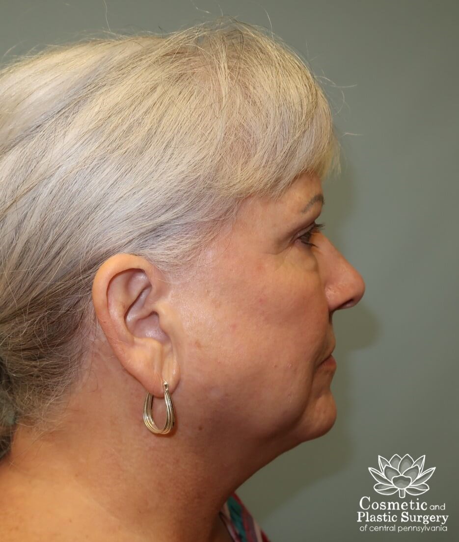 Facelift and Necklift Before
