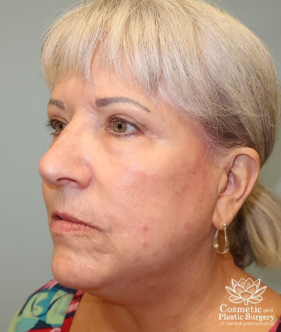 Facelift and Necklift Before