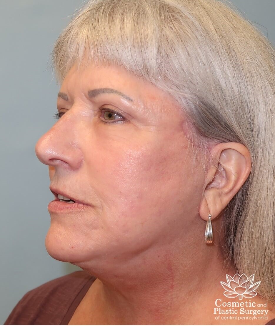 Facelift and Necklift After