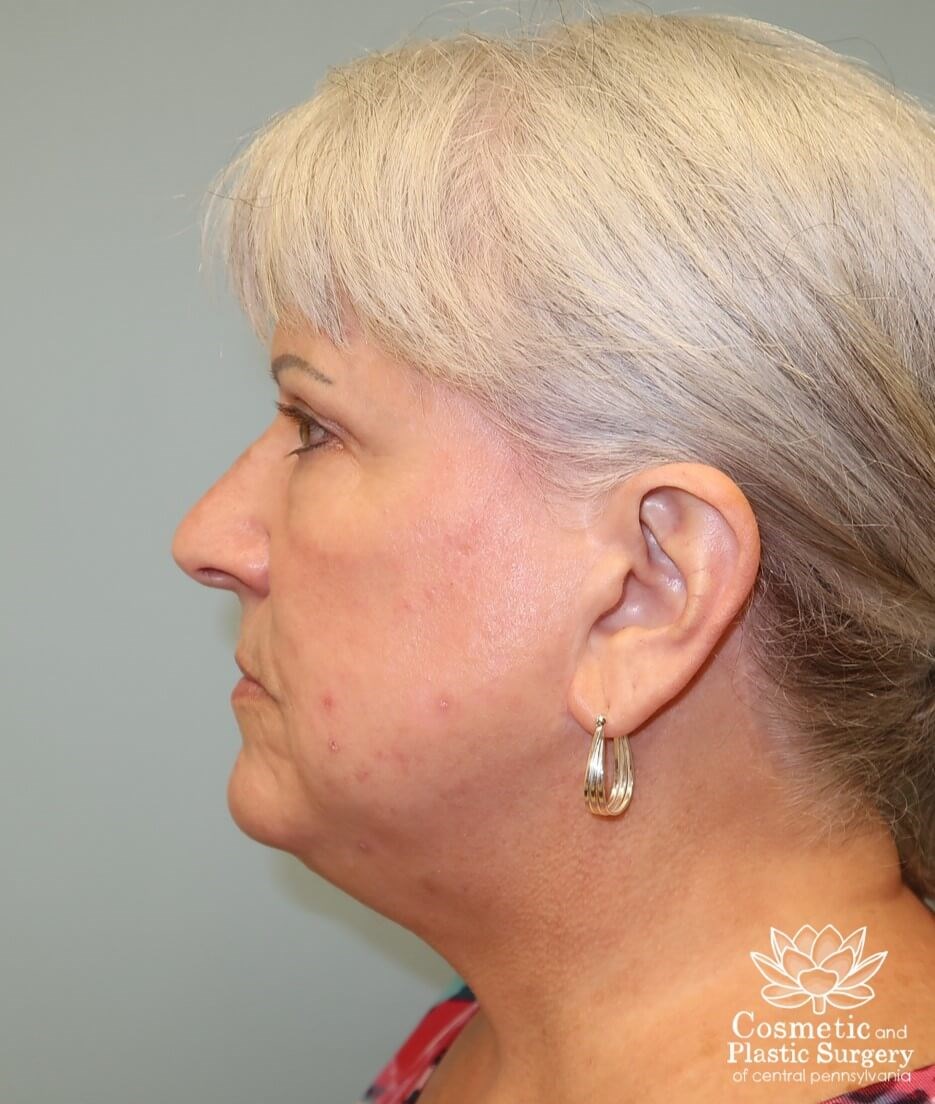 Facelift and Necklift Before