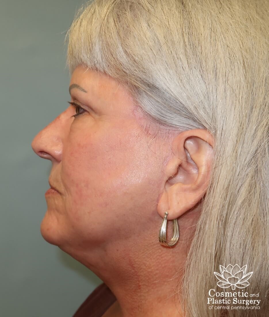 Facelift and Necklift After