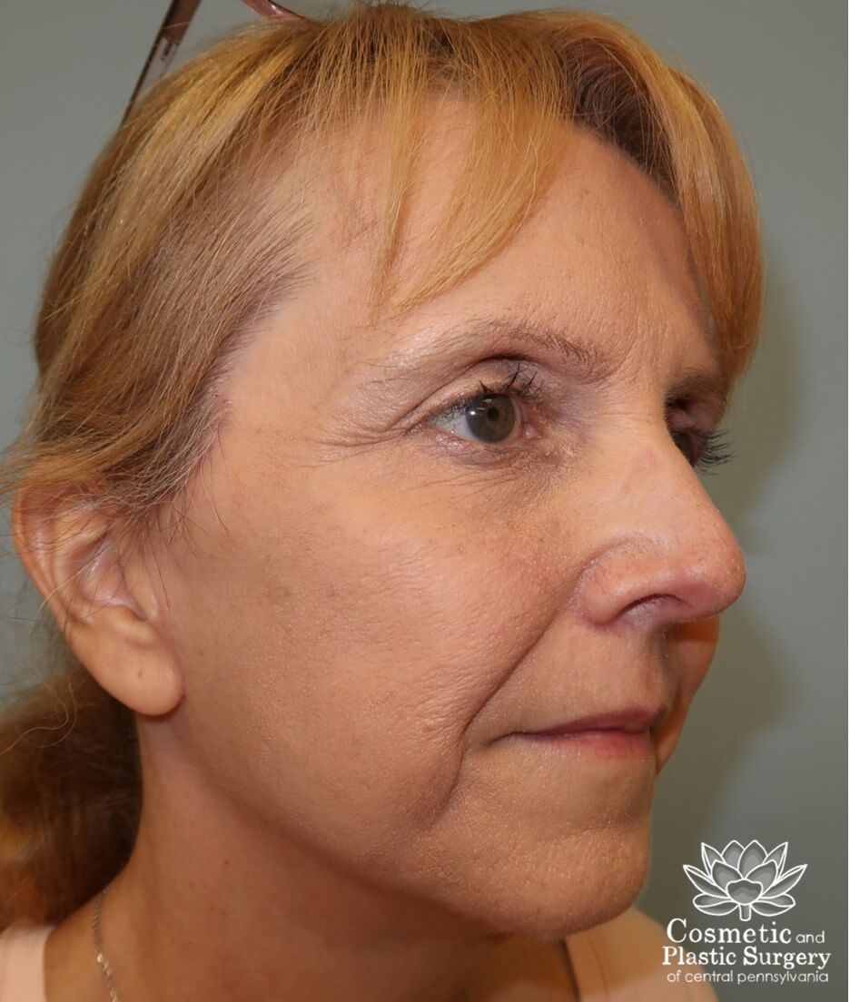 Facelift After