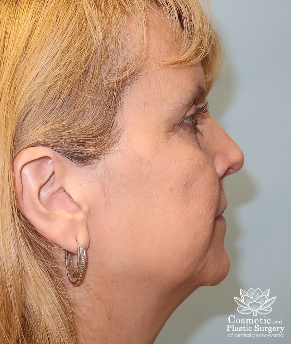 Facelift Before