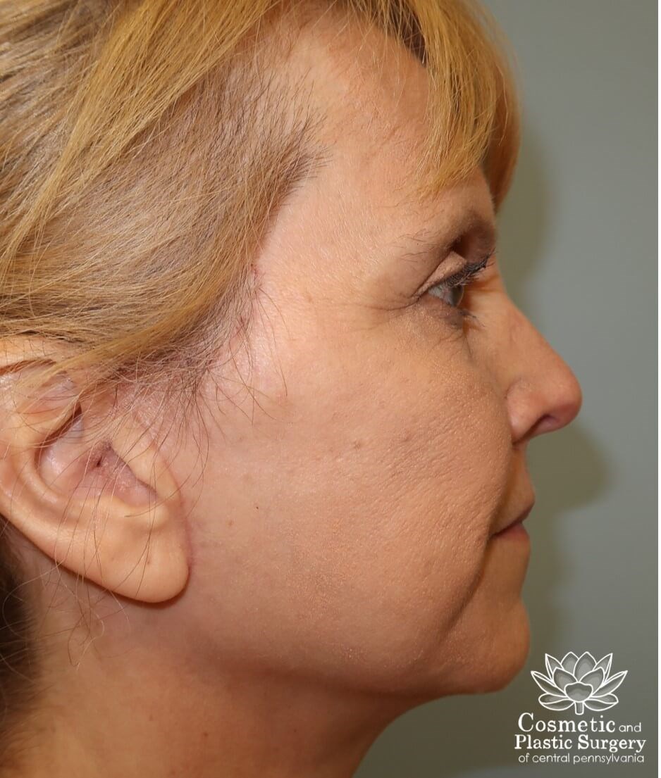 Facelift After