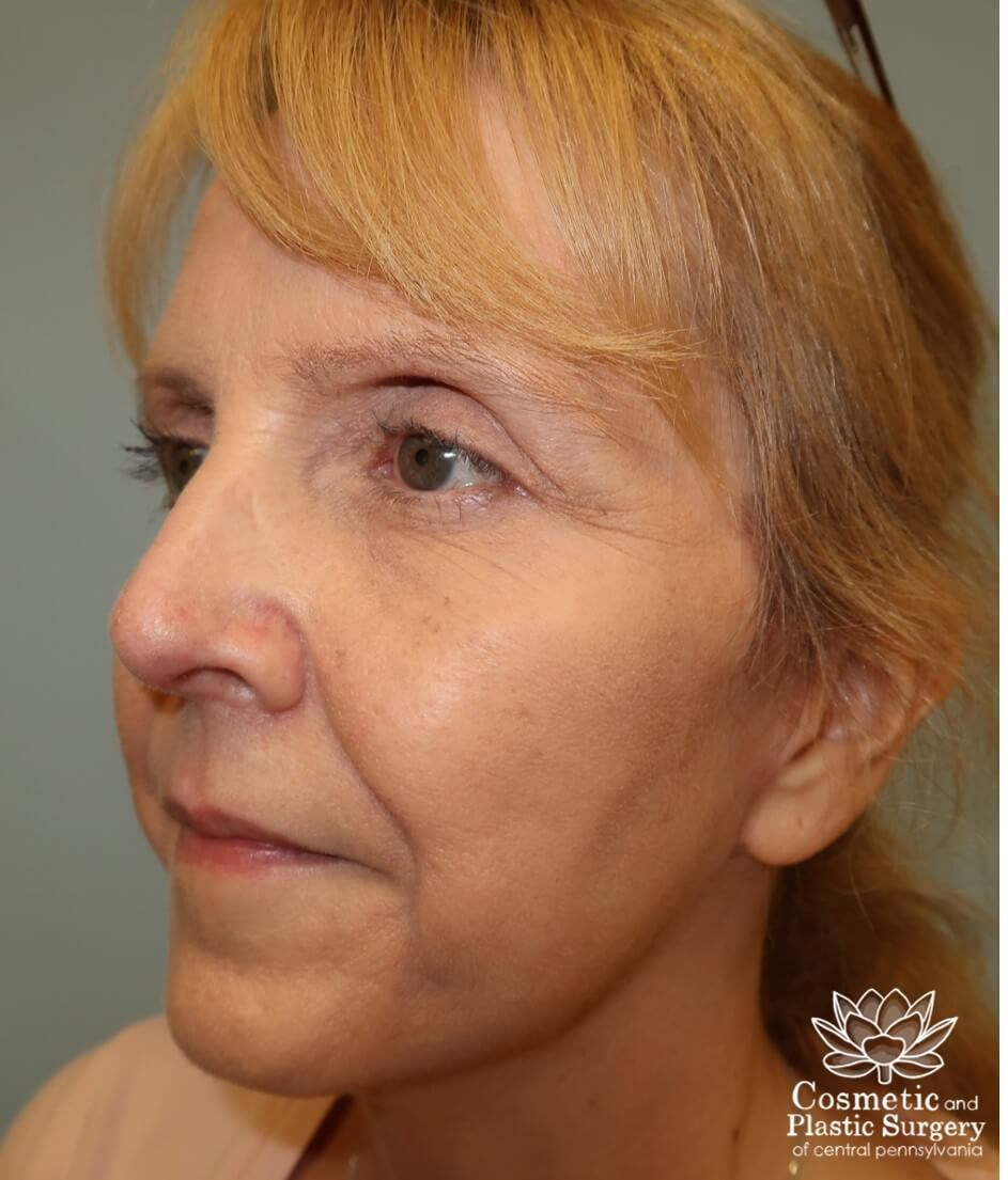 Facelift After