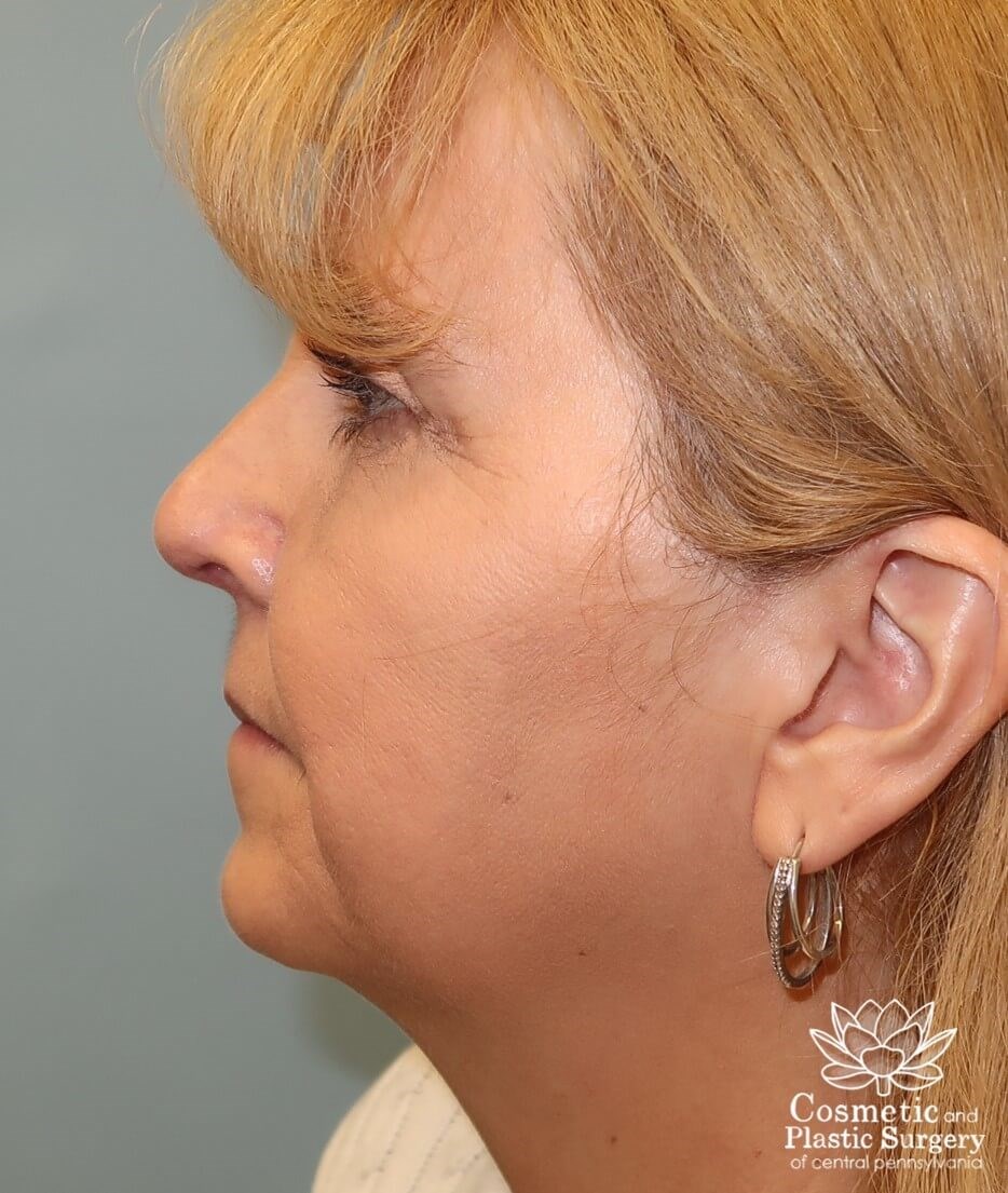 Facelift Before