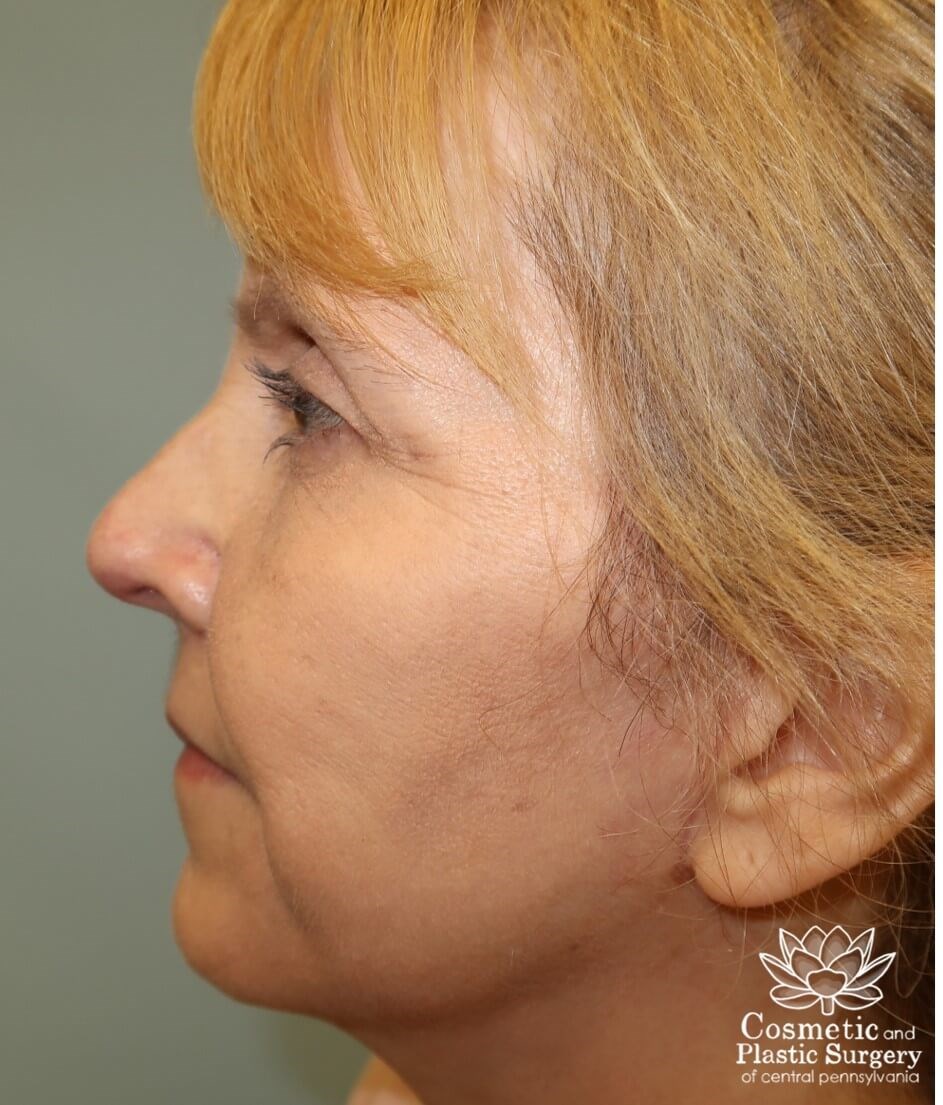Facelift After