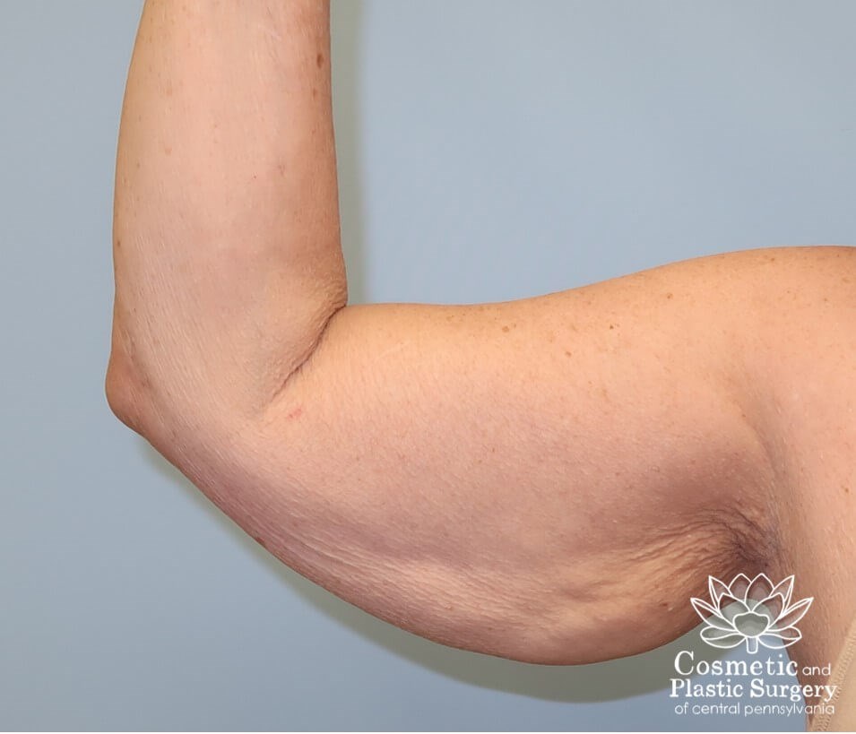 Arm Lift - brachioplasty Before
