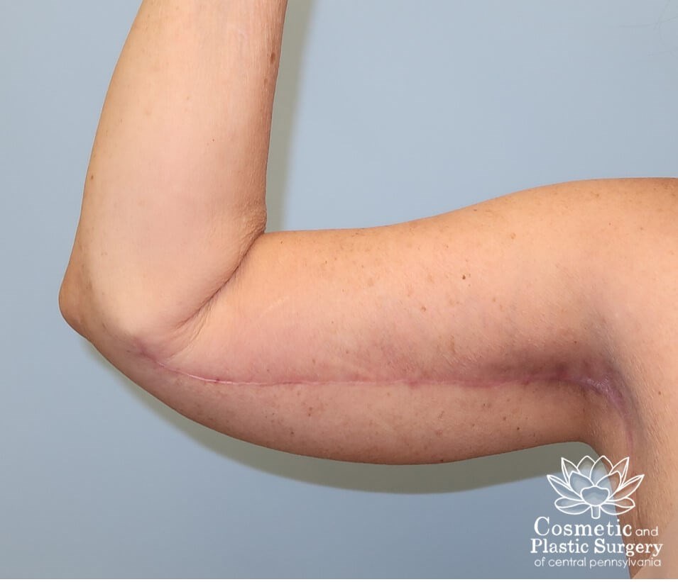 Arm Lift - brachioplasty After
