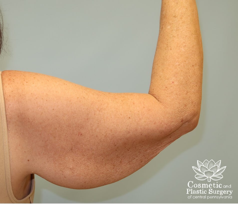 Arm Lift - brachioplasty Before