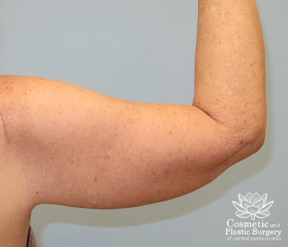 Arm Lift - brachioplasty After