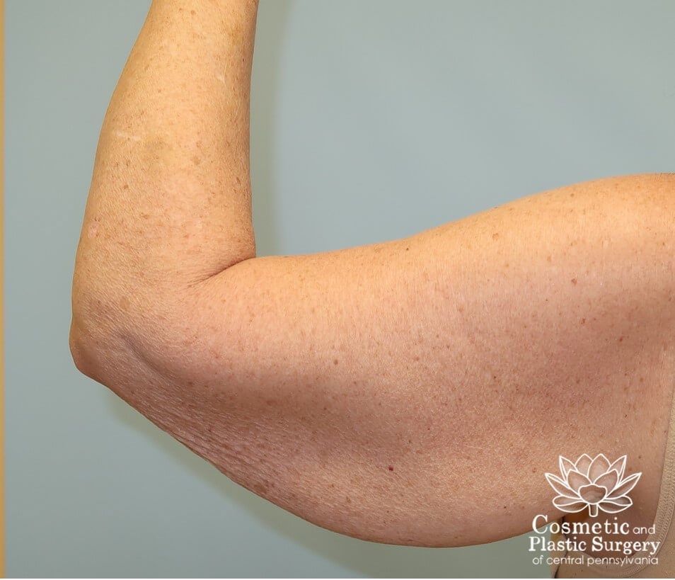 Arm Lift - brachioplasty Before