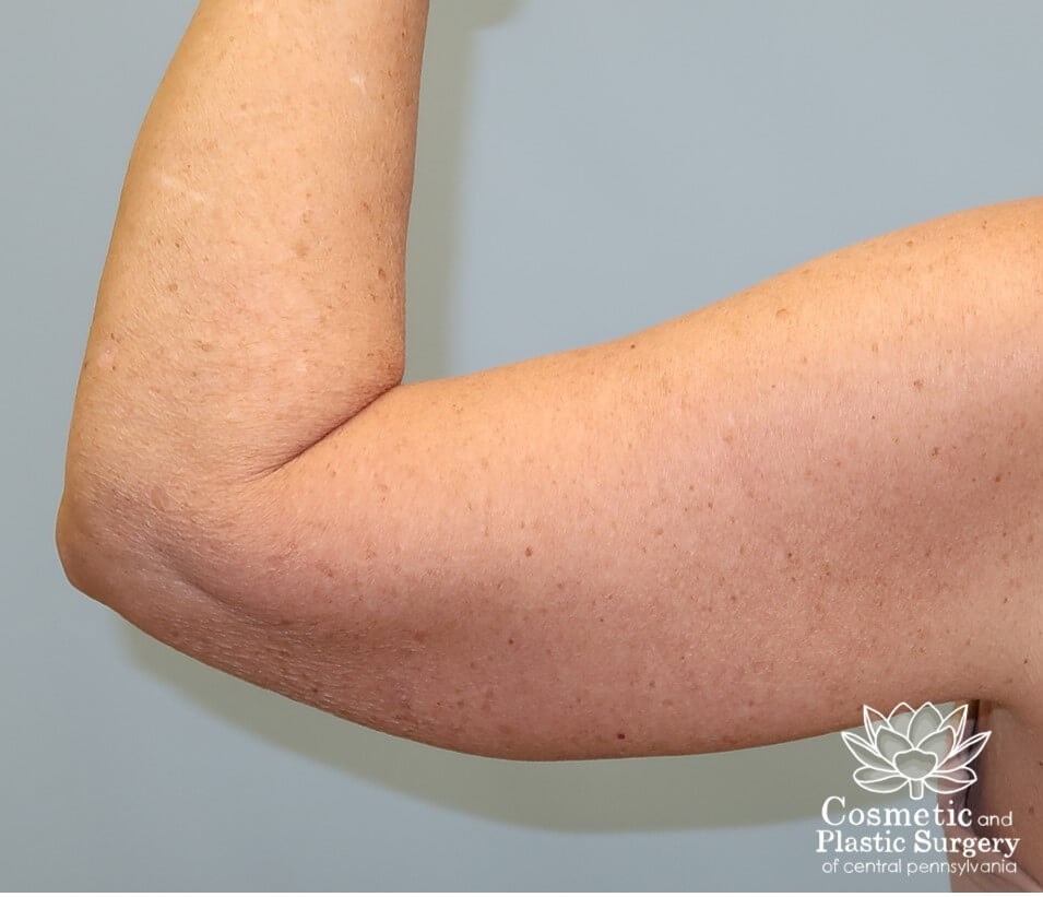 Arm Lift - brachioplasty After