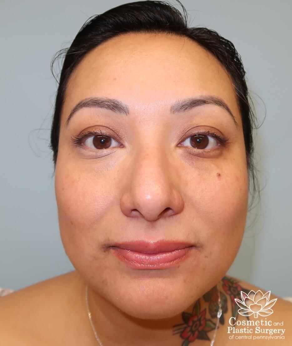 Lower Blepharoplasty Before