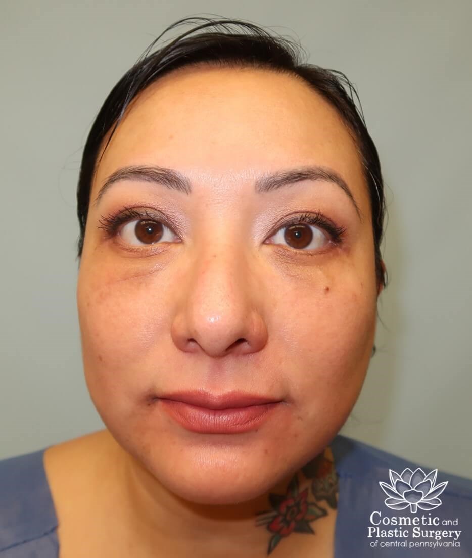 Lower Blepharoplasty After