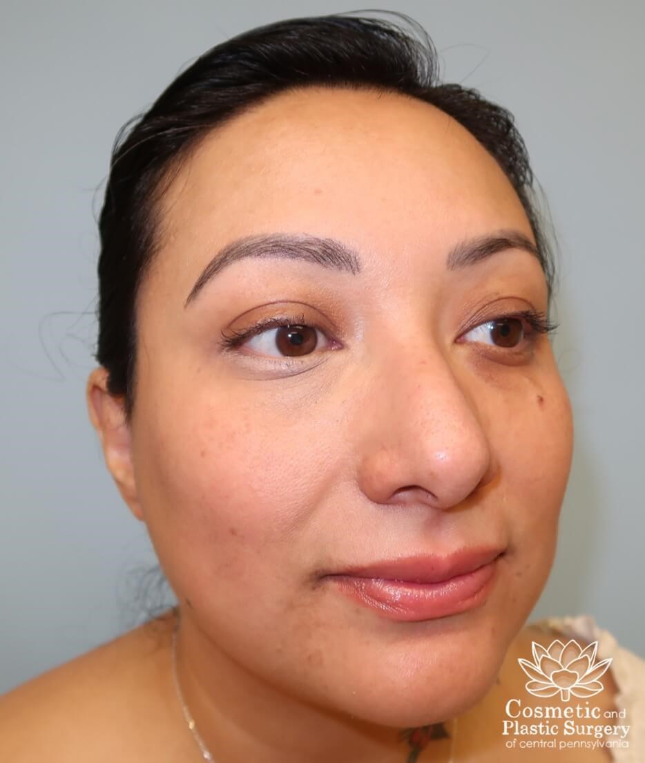 Lower Blepharoplasty Before