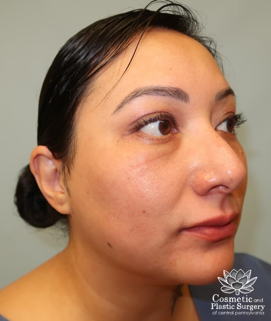 Lower Blepharoplasty After