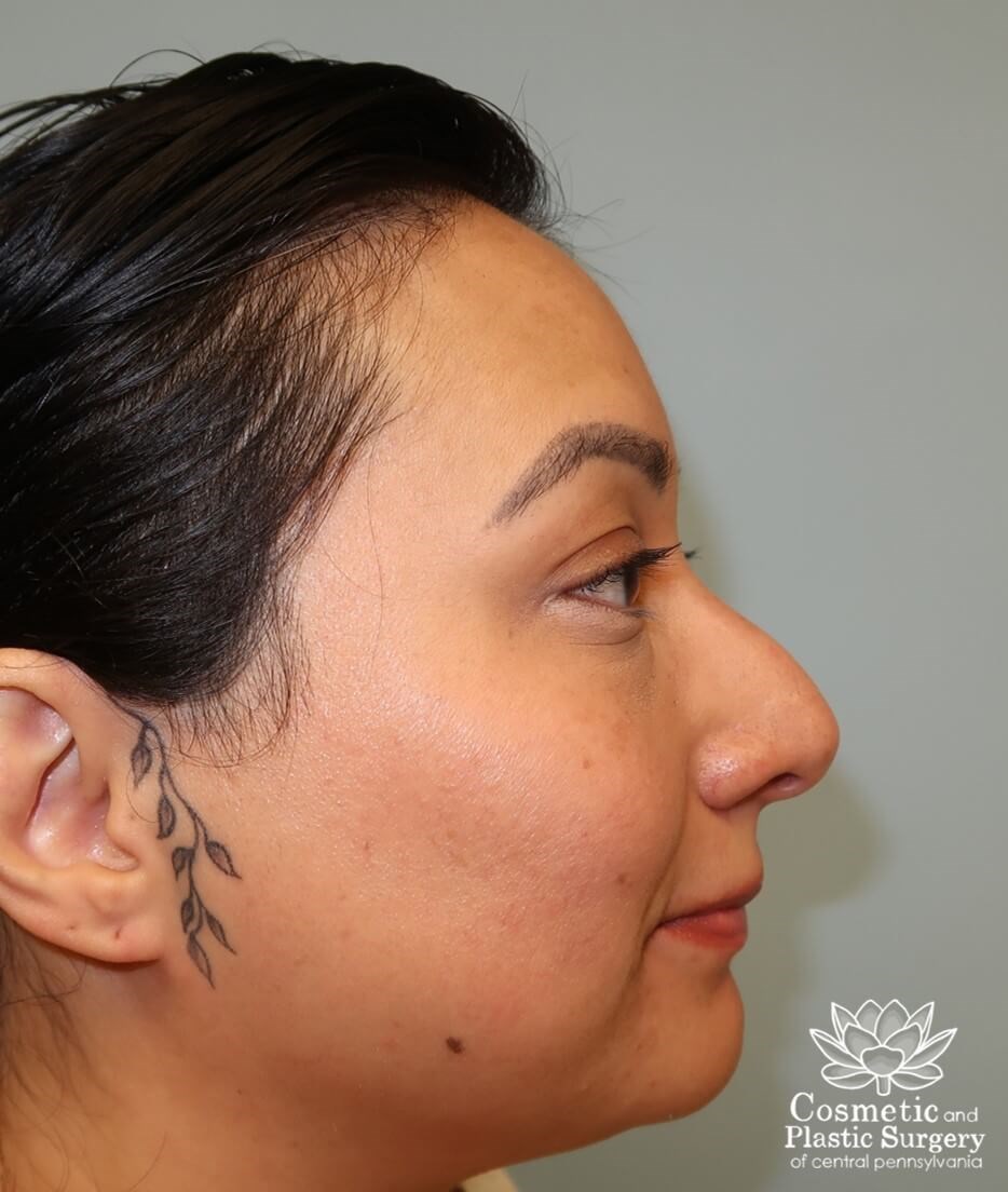 Lower Blepharoplasty Before