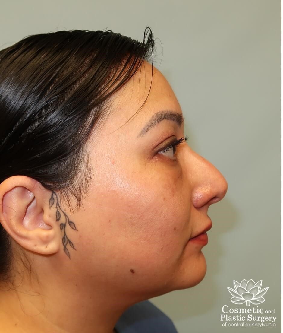 Lower Blepharoplasty After