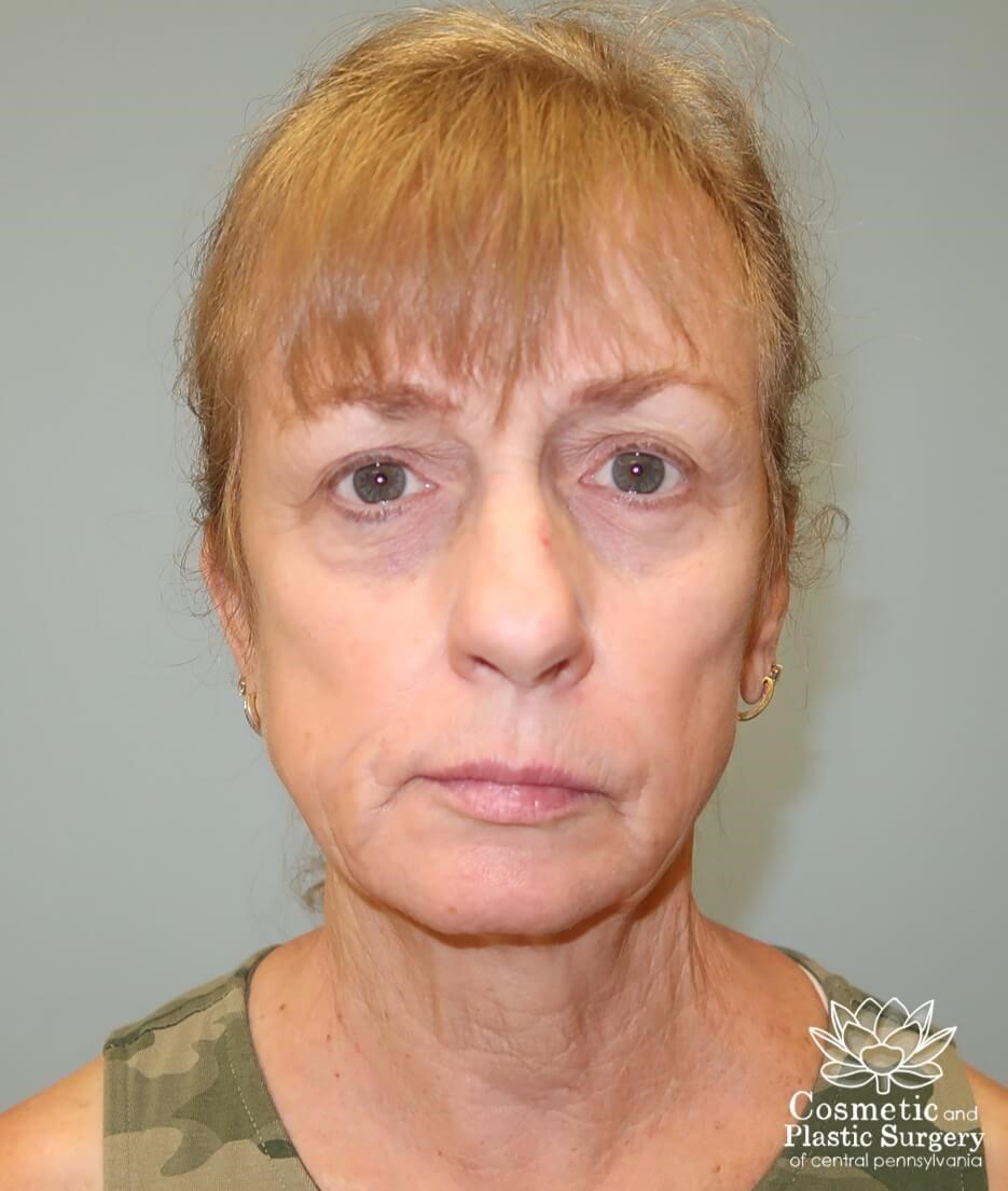 Facelift Before