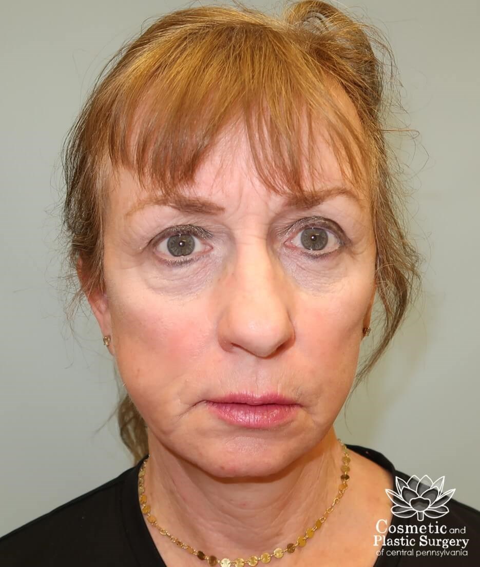 Facelift After