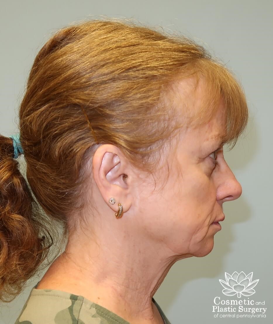 Facelift Before