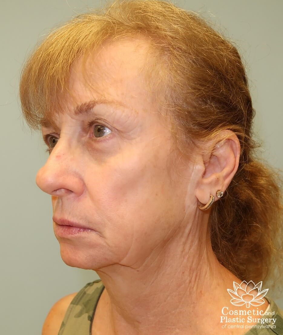 Facelift Before