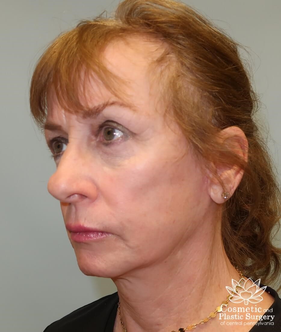 Facelift After