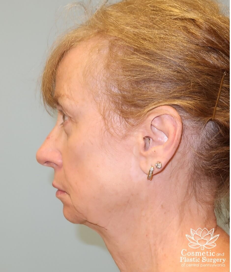 Facelift Before