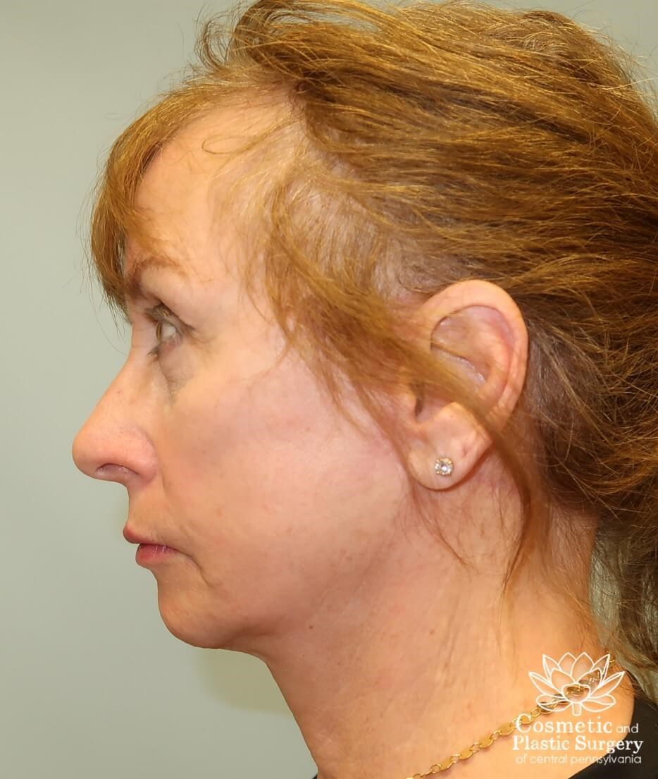 Facelift After