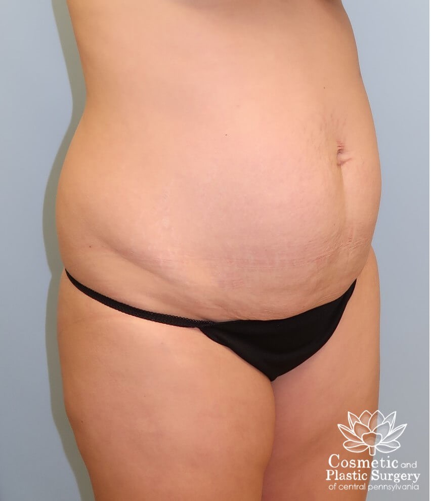 Abdominoplasty (Tummy Tuck) Before