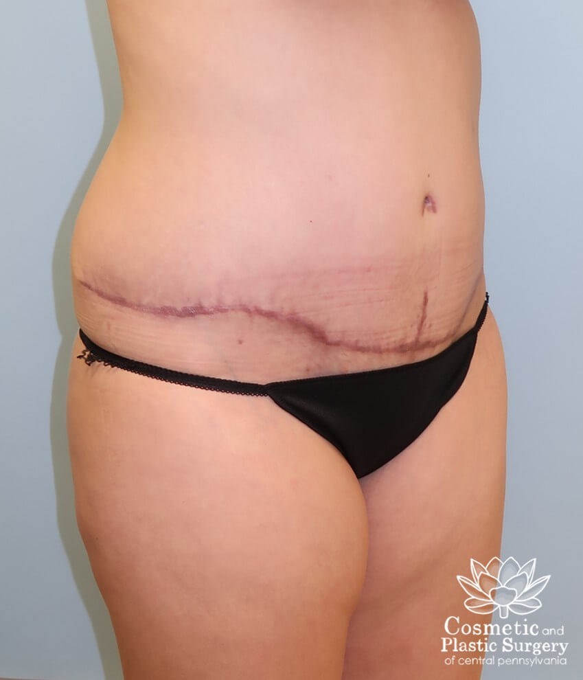Abdominoplasty (Tummy Tuck) After