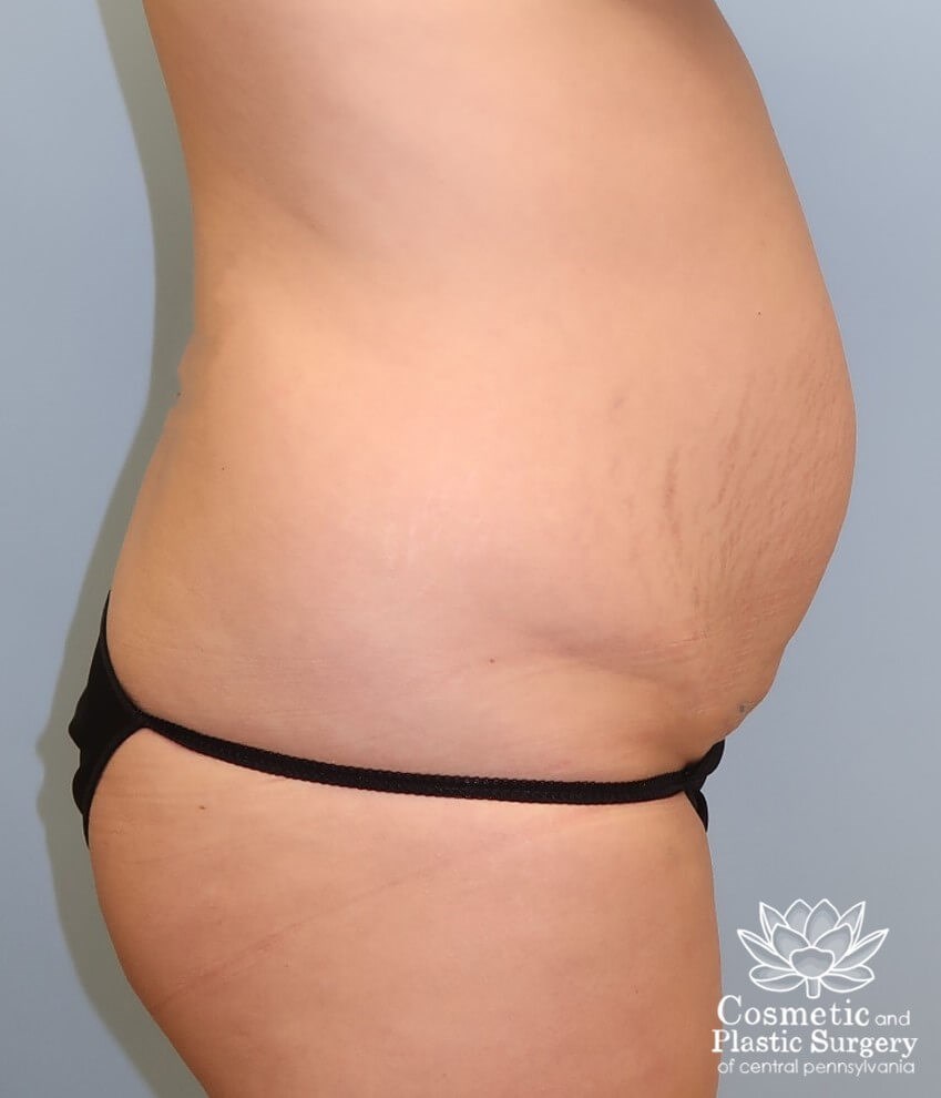 Abdominoplasty (Tummy Tuck) Before